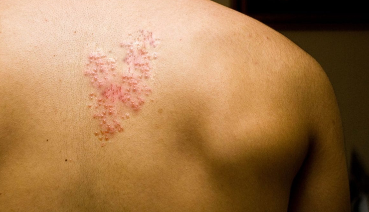 6 Natural Remedies To Treat Shingles Symptoms