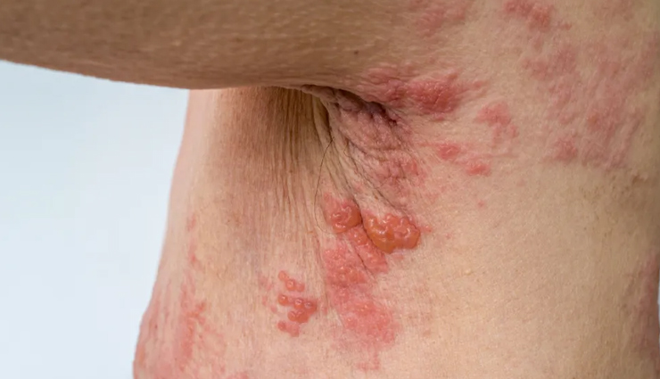 6 Natural Solutions for Shingles on Skin

