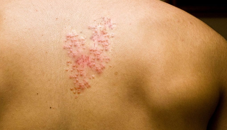 6 Home Remedies Effective To Treat Shingles
