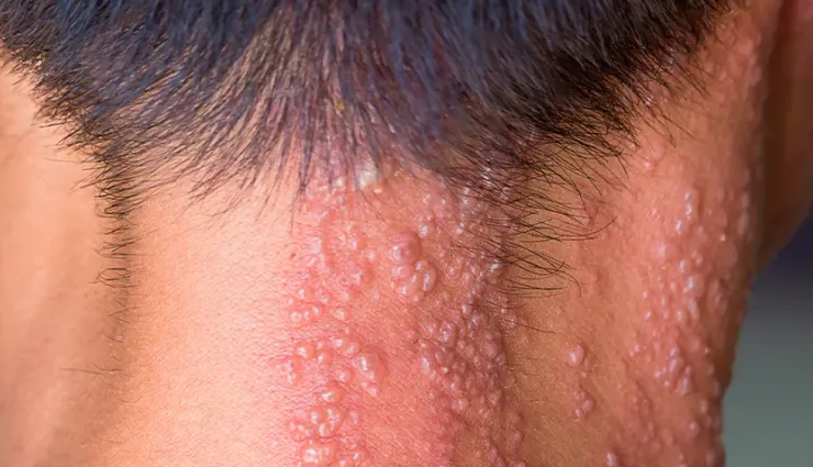 scalp scabs treatment,treating scabs on the scalp,get rid of scalp scabs,home remedies for scalp scabs,scalp care tips,scab removal methods,scalp health advice,healing scalp sores,natural remedies for scalp scabs,preventing scalp scabs