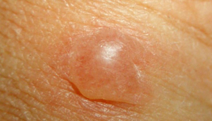 skin cancer symptoms,skin cancer types,skin cancer on face,skin cancer treatment,skin cancer on nose,skin cancer black skin,skin cancer by race,vitamin b skin cancer benefits,skin cancer color,skin cancer center,skin cancer cream,skin cancer color ribbon,vitamin c skin cancer treatment,vitamin c skin cancer prevention,skin cancer diagnosis,skin cancer detection,vitamin d skin cancer,vitamin d skin cancer treatment