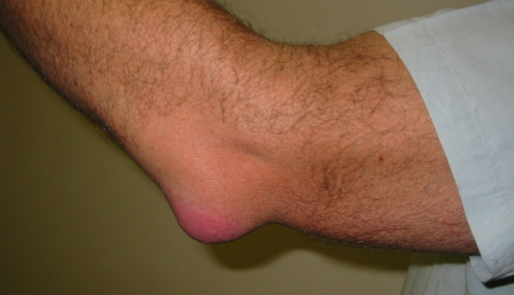 shoulder pain,causes of shoulder pain,Health tips,fitness tips