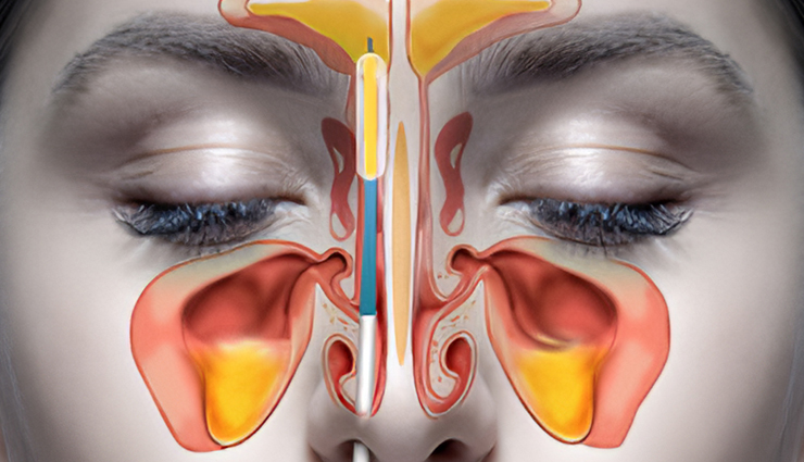 This Ingredient Will Cure Sinus Infection in Just 2 Minutes