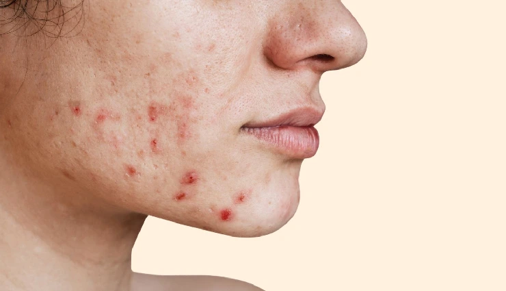 6 Home Remedies To Treat Skin Outbreaks