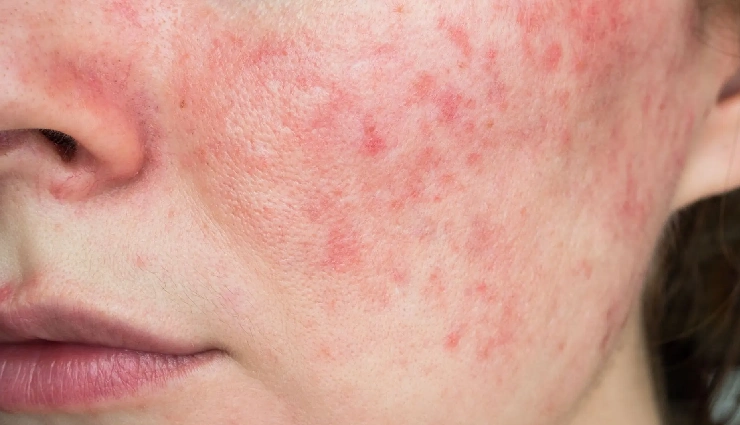 10 Must Try Home Remedies To Treat Skin Inflammation