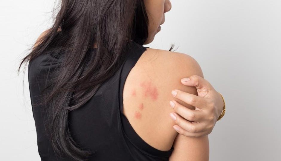8 Home Remedies to Treat Skin Allergies in Summers