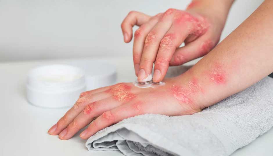 10 Home Remedies to Treat Skin Allergies During Monsoon