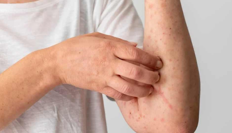 9 Home Remedies To Treat Mild Skin Allergies