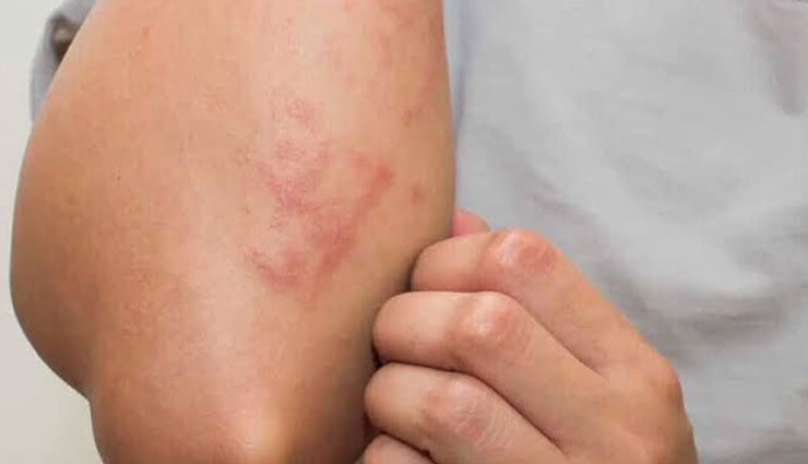 5 Instant Ways To Get Rid of Skin Allergy