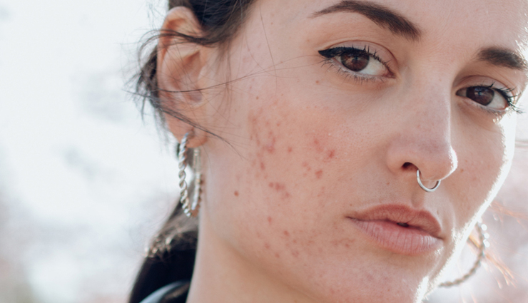 6 Herbal Remedies To Get Rid of Dull Skin at Home