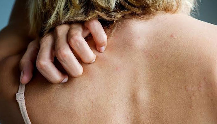skin allergy,home remedies,home remedies for skin allergy,allergy care tips,Health tips,fitness tips