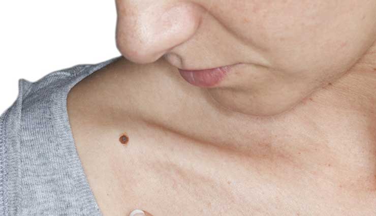 शोध : वजन घटाने की सर्जरी से कम होता है त्वचा कैंसर का खतरा