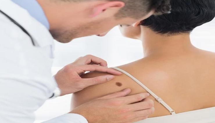 इन लोगों को स्किन कैंसर का जोखिम ज्यादा, कहीं आप भी तो नहीं इनमें शामिल