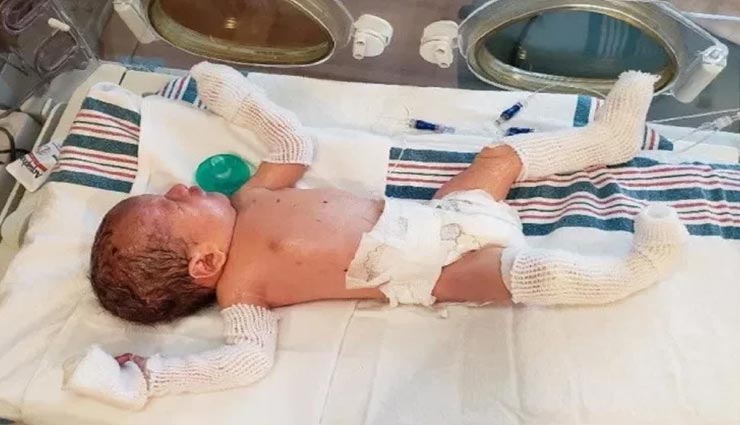 weird news,weird disease,skin disease,rare skin disease,parents can not be hugged son,child skin falls off,america,california