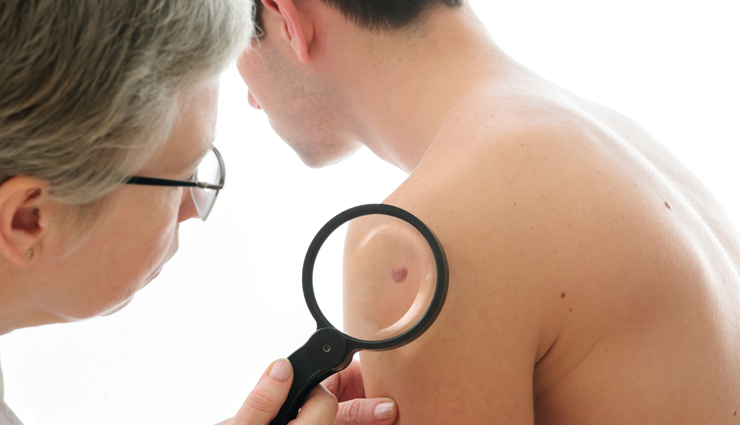 types of skin disorder,skin disorder that leave permanent effect,skin care tips,beauty tips