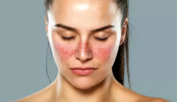types of skin disorder,skin disorder that leave permanent effect,skin care tips,beauty tips
