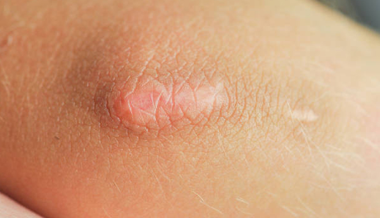 bed sores,pressure sores,bed sore treatment,bed sore treatment and prevention,home remedies for dry skin,skin sores,bed sores treatment at home,bed sore symptoms,medicine for bed sores,bed ulcers,best treatment for bed sores,treatment for pressure sores,prevention of pressure ulcers,bed sore prevention,home remedies for bed sores,natural remedies for dry skin,sores on body,pressure sore prevention,bed for bed sores,remedy for bed sores,best medicine for bed sores,bandage for bed sores