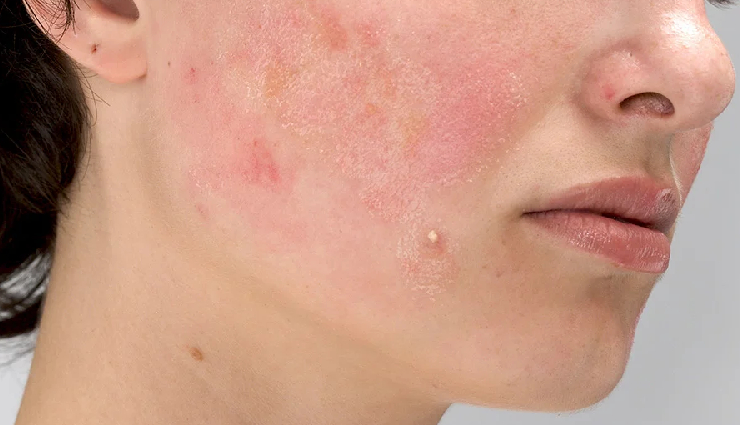 home remedies for heat pimples,treat heat pimples naturally,heat pimple home remedies,quick tips to heal heat pimples,remedies for summer acne,natural solutions for heat-related pimples,cooling remedies for heat-induced acne,fast ways to get rid of heat pimples,heat rash remedies for the skin,soothing treatments for summer acne,diy remedies for heat-related breakouts,effective home treatments for heat pimples,heal heat pimples with natural ingredients,cooling skincare for summer acne,natural remedies for quick relief from heat pimples,home solutions for heat-induced skin irritation,tips to reduce inflammation in heat pimples,homeopathic treatments for heat-related acne,cooling masks for quick heat pimple relief,summer skincare tips for preventing heat pimples