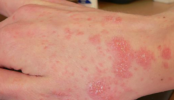 castor oil,benefits of castor oil,castor oil health benefits,health benefits of castor oil,Health,Health tips,healthy food