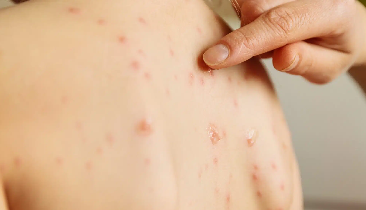 common childhood diseases,children illnesses symptoms,kids common ailments,childhood disease signs,pediatric health issues,pediatric health conditions,childhood ailments signs,common child health issues,symptoms of kids diseases,childhood sicknesses signs,common pediatric ailments,child health problems symptoms,children health disorders,common illnesses in infants,early signs of child diseases