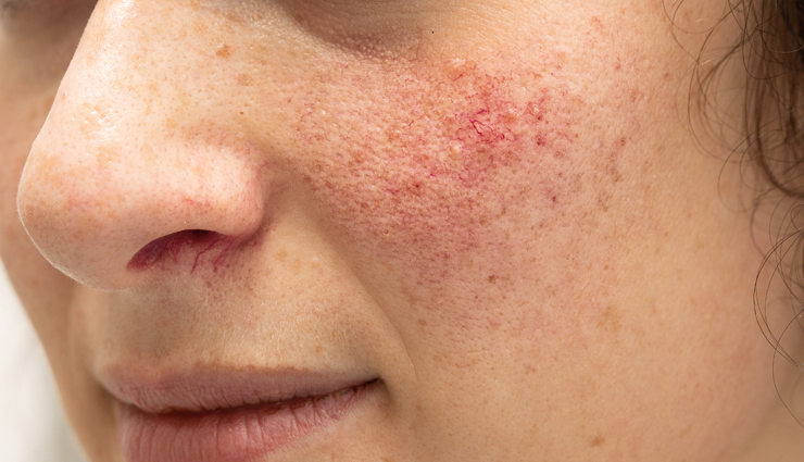 skin whitening,tomato for skin whitening,skin whitening tips,benefits of using tomato for skin,skin care,skin care tips,benefits of tomato for skin