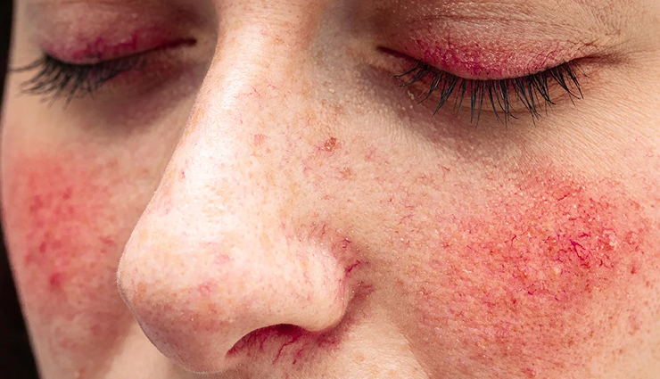 clove oil side effects,negative effects of clove oil,clove oil health risks,adverse reactions to clove oil,dangers of clove oil,clove oil toxicity,clove oil allergic reactions,clove oil overdose,clove oil poisoning,harmful effects of clove oil on health,clove oil adverse effects,clove oil precautions,clove oil safety concerns,clove oil allergic sensitivity,clove oil overdose symptoms,risks of using clove oil,clove oil side effects on skin,clove oil ingestion dangers,clove oil topical reactions,clove oil inhalation hazards