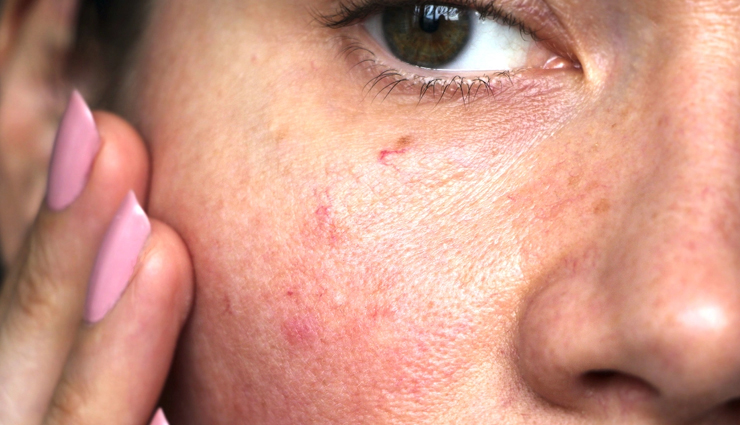 gram flour for skin problems,using gram flour for skin issues,benefits of gram flour for skin,gram flour remedies for skin problems,how to solve skin problems with gram flour,natural skincare with gram flour,gram flour for healthy skin,diy gram flour treatments for skin problems,gram flour face mask for skin issues,gram flour skincare tips