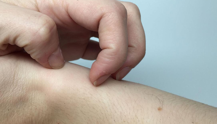 skin irritation during summer,home remedies to treat skin irritation,summer skin care tips,beauty tips,skin care tips