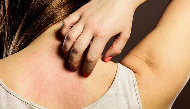 5 Quick Ways To Treat Skin Itching During Summer