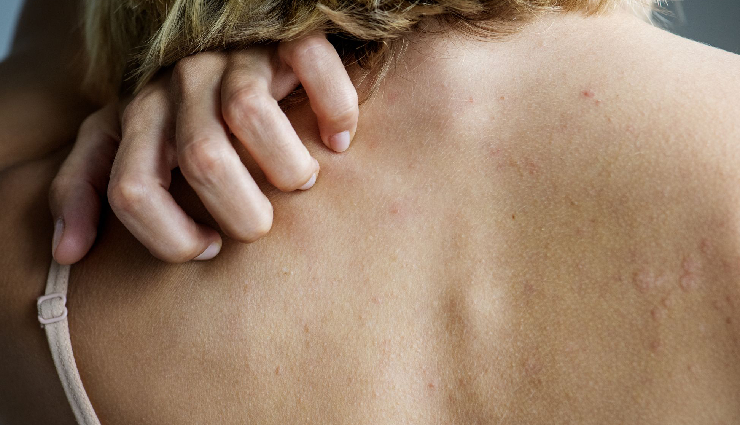 liver damage signs,skin abnormalities liver damage,blue rashes liver disease,skin itching liver damage,spider angioma liver dysfunction,halitosis liver impairment,palmar erythema liver damage,facial hyperpigmentation liver dysfunction,liver health warning signs,symptoms of liver damage