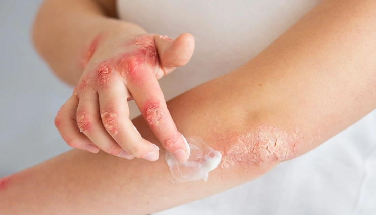 sunburn relief,aloe vera for sunburn,natural sunburn remedy,soothe sun-damaged skin,aloe vera benefits,summer skincare,aloe gel,healing sunburn,sunburn treatment,after-sun care