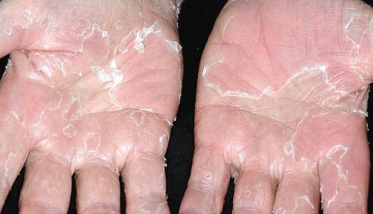 क्या आपके भी हाथ और पैर की निकलने लगती हैं स्किन, जानें कारण और उपाय
