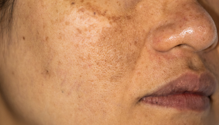 amazing benefits of applying sunscreen,sunscreen benefits,sun protection,spf importance,sunscreen application,uv radiation protection,sunscreen efficacy,skin protection tips,skin cancer prevention,anti-aging skincare,sunscreen frequency,sunburn prevention,skin discoloration prevention,uv radiation effects,sunscreen for sensitive skin,sunscreen ingredients