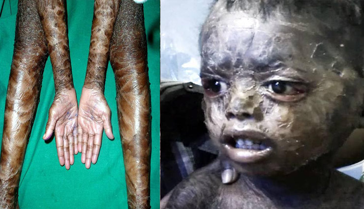 सांप की तरह खाल छोड़ता है यह बच्चा, इस खतरनाक बीमारी से है ग्रसित odisha,boy.skin.skin problem,weird news in hindi