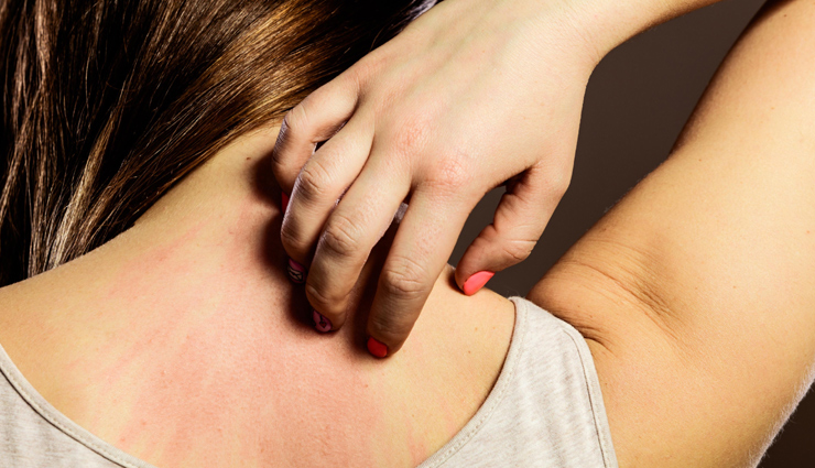 fungal acne explanation,understanding fungal acne,causes of fungal acne,symptoms of fungal acne,fungal acne treatments,fungal acne overview,fungal acne causes and remedies,how to treat fungal acne,fungal acne skin issues,fungal acne management