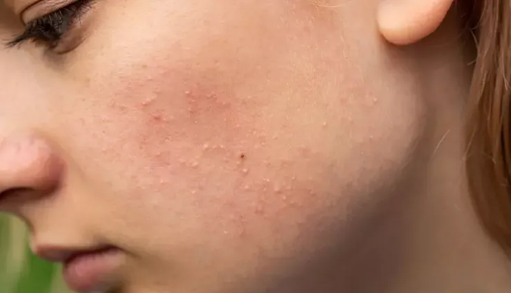 prickly pear seed oil disadvantages,drawbacks of using prickly pear oil on skin,limited benefits of cactus seed oil for skin,prickly pear oil minimal impact on skin,prickly pear seed oil downsides,skin concerns with prickly pear oil use,less advantageous aspects of cactus oil for skin,negative effects of prickly pear seed oil on skin,prickly pear oil limitations for skin care,evaluating the lesser benefits of cactus seed oil