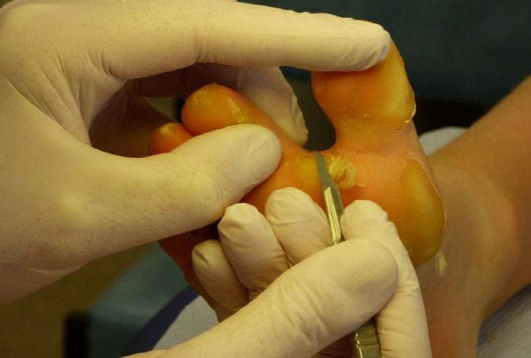 pachyonychia-congenita-disease dad-sons-rare-skin-problem