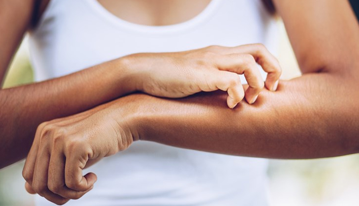 get rid of eczema,tips to get rid of eczema,beauty tips,beauty hacks,skin infection treating tips