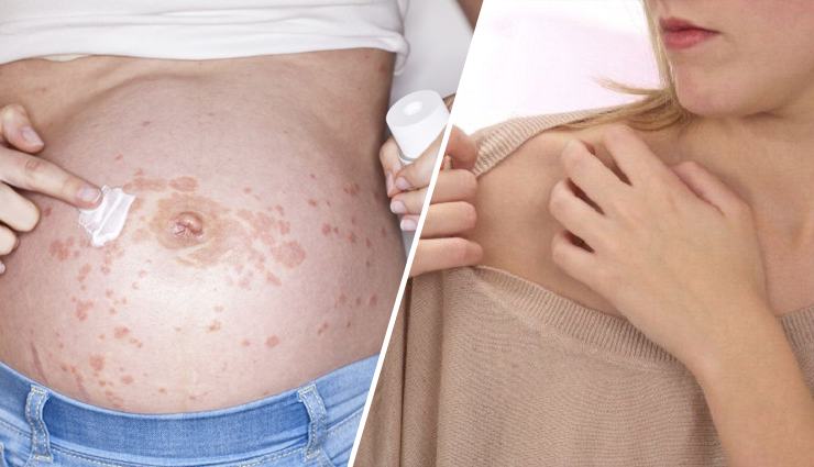 6 Home Remedies To Treat Skin Rashes During Pregnancy