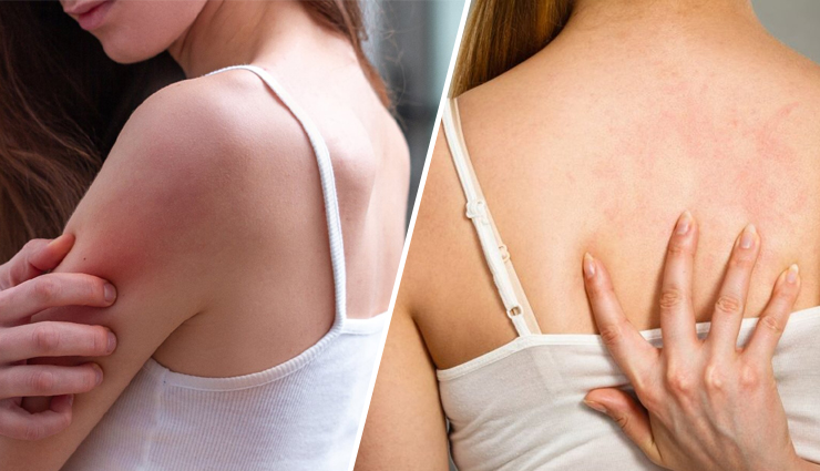 8 DIY  Ways To Treat Skin Monsoon Rashes