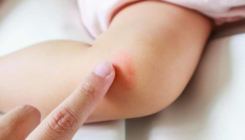 15 Home Remedies To Treat Skin Redness in Kids