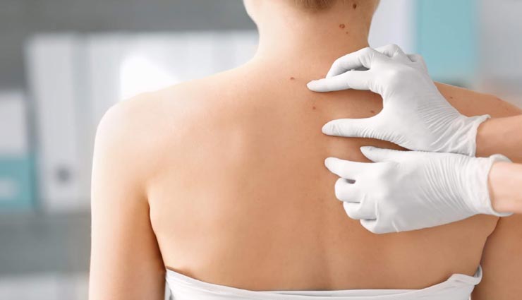 मस्सों से छुटकारा दिलाएंगे ये घरेलू उपाय, वो भी बिना सर्जरी के