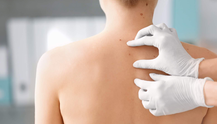 Home Remedies To Get Rid of Skin Tags