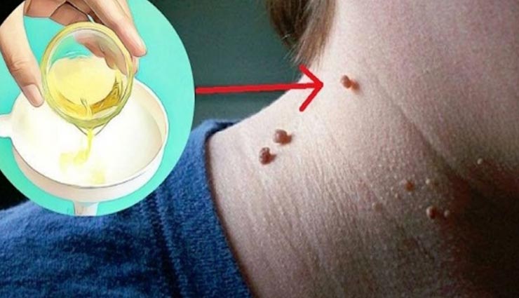 मस्सों की समस्या का अब होगा अंत, ये 6 ऑयल दिखाएंगे अपना कमाल, जानें इस्तेमाल का तरीका