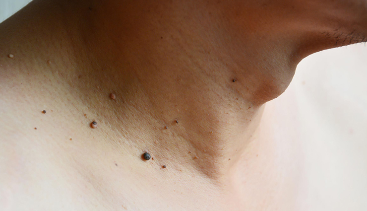 Tips and Tricks To Get Rid of Skin Tags