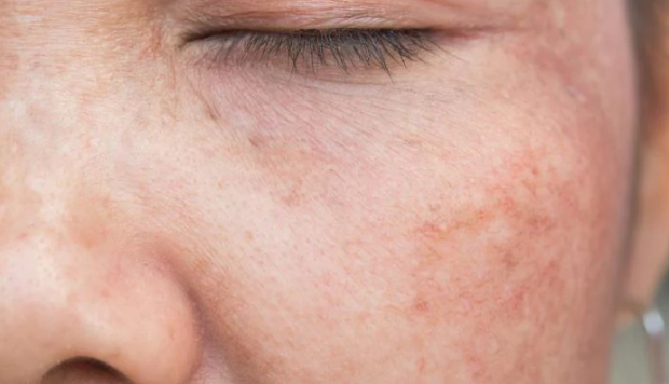 vitamin e benefits for skin,amazing skin benefits of vitamin e,using vitamin e for healthy skin,natural skincare with vitamin e,vitamin e for radiant skin,benefits of applying vitamin e on skin,vitamin e for moisturized and smooth skin,antioxidant properties of vitamin e for skin,vitamin e in skincare routines,how vitamin e enhances skin health