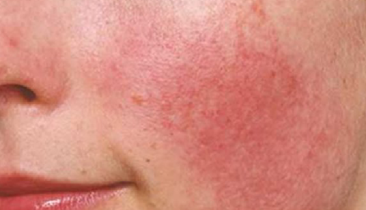 expired cosmetics side effects,skin irritation from expired makeup,allergic reactions to expired skincare,bacterial contamination in cosmetics,acne from expired products,accelerated aging due to expired skincare,skin sensitization by expired cosmetics,discoloration from expired makeup,uneven skin tone caused by expired products,compromised skin barrier from expired cosmetics,risks of using expired beauty products,effects of expired cosmetics on skin health,harmful effects of expired makeup,dangers of using expired skincare,consequences of using old cosmetics on skin