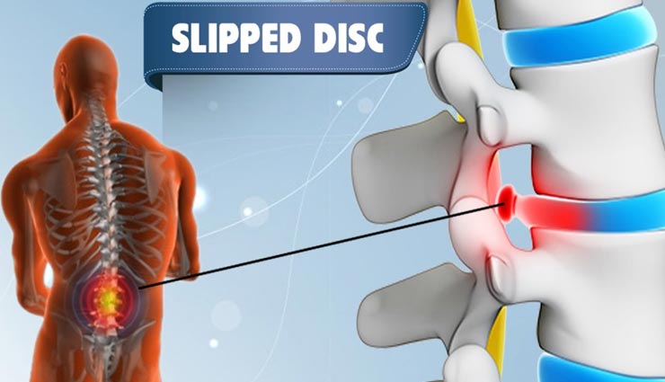 क्या स्लिप डिस्क का दर्द आपको भी कर रहा परेशान, ये 4 योगासन दिलाएंगे आराम
