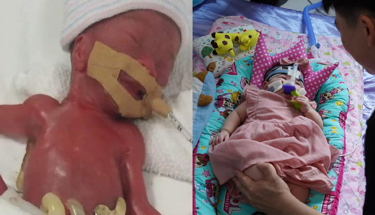 घर लौटी दुनिया की सबसे छोटी बच्ची, जन्म के वक्त सेब जितना था वजन