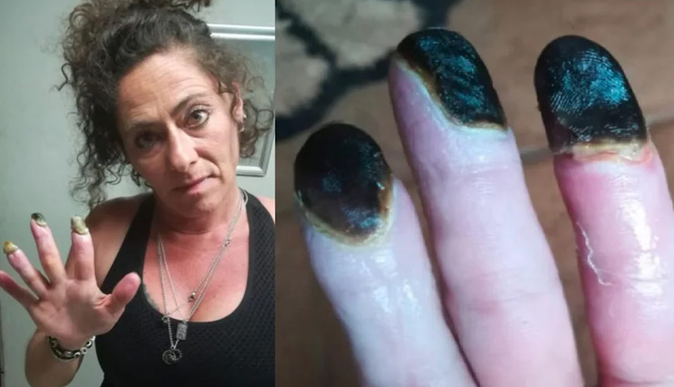 एक दिन में पीती थी 15 सिगरेट, अब गल रही है उंगलियां 